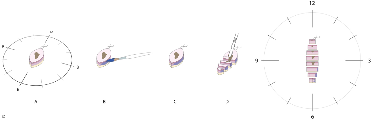 Brotlaib-Tchnik Schnittechnik Dermatologie Dermatohistologie 3D Diagnostik