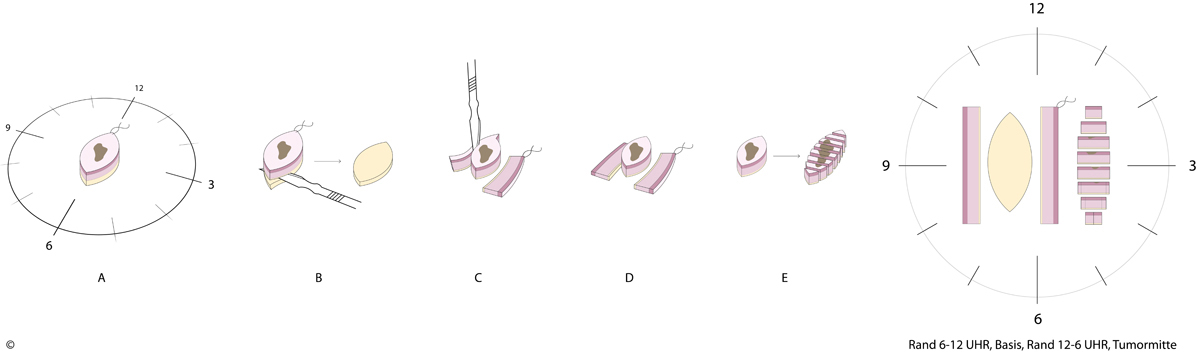 Tübinger Torte Schnittechnik Dermatologie Dermatohistologie 3D Diagnostik